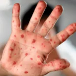 Detectan la cepa más peligrosa de viruela del mono en la Argentina y un hombre está internado